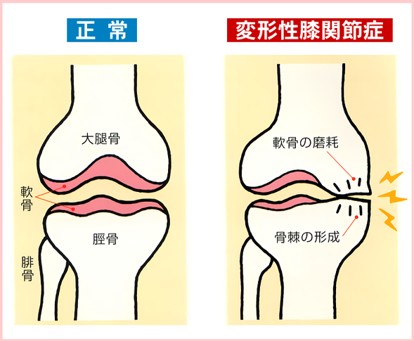 変形性膝関節症のメカニズム